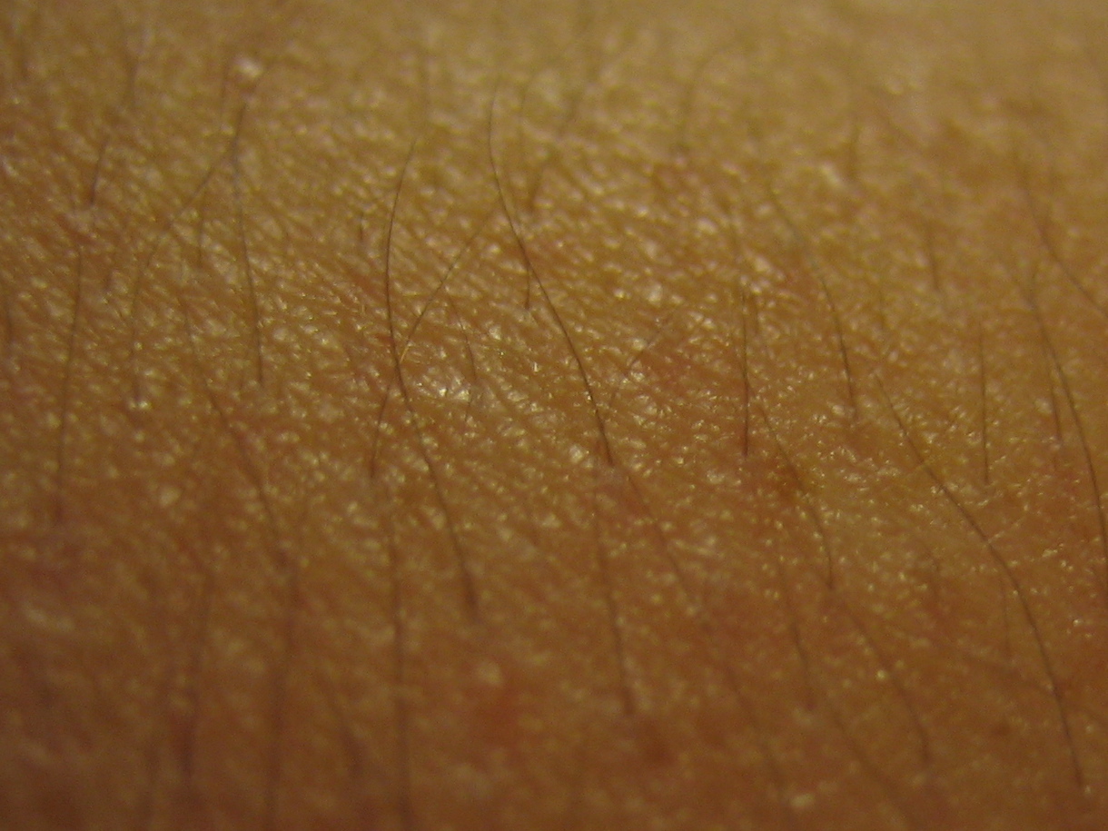 KP And Other Diseases that Cause Bumps On Skin Diseases that Cause Bumps On Skin