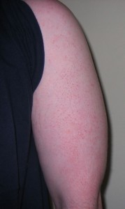 keratosis pilaris causes bumps harmful goose rid sufferers unsightly nothing though many than would