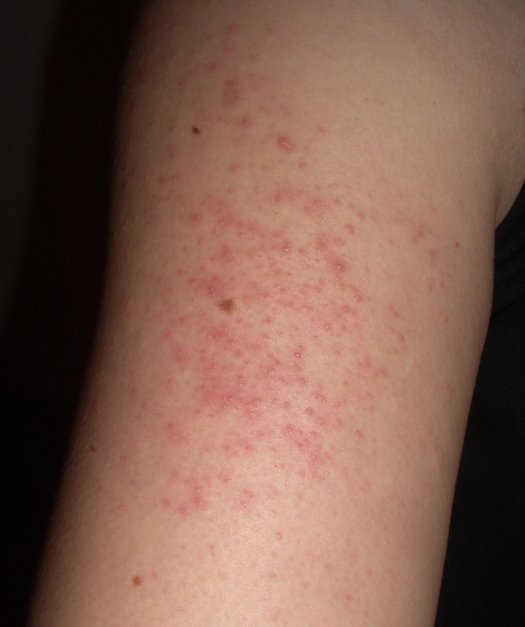 what is keratosis pilaris