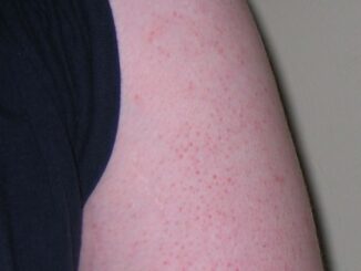 what causes keratosis pilaris