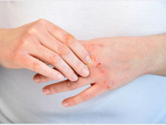 hand eczema treatment