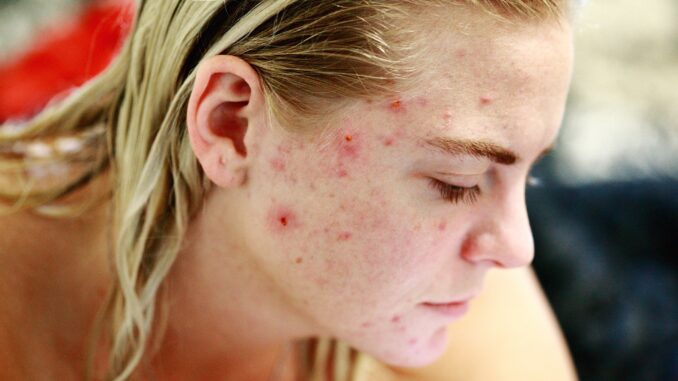 Keratosis Pilaris on Face