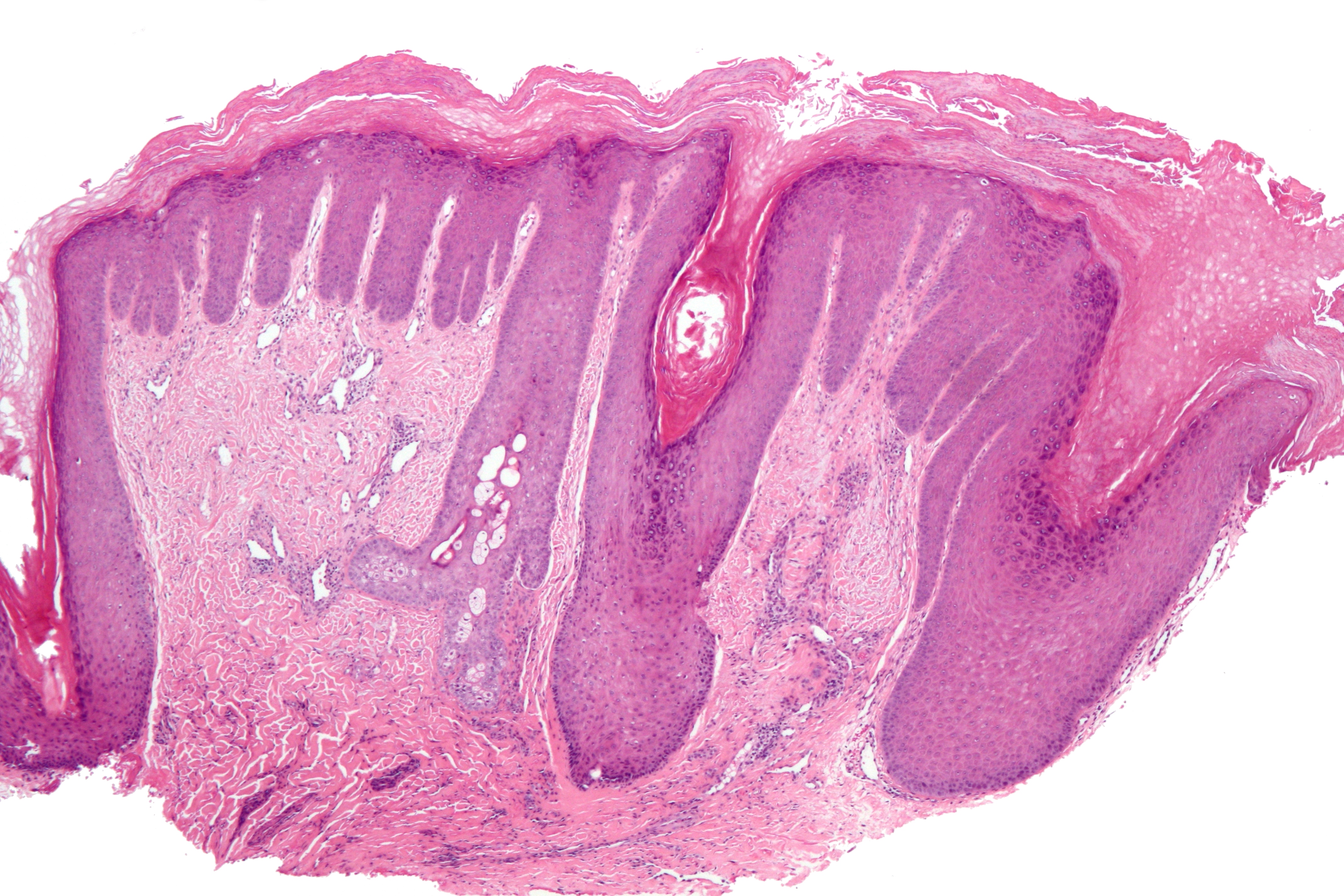 What Does Keratosis Pilaris Look Like?